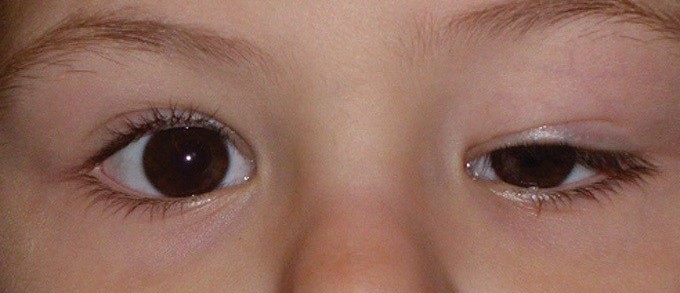 پتوز یا افتادگی پلک Ptosis