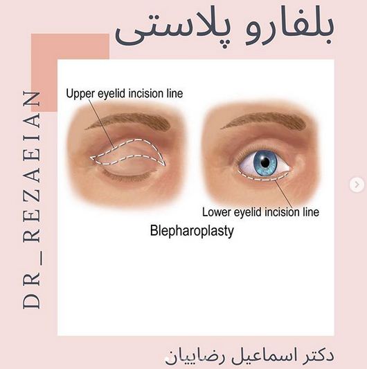   جراحی زیبایی پلک یا بلفاروپلاستی 