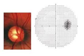  جراحیهای لیزری و غیر لیزری آب سیاه ( گلوکوم)